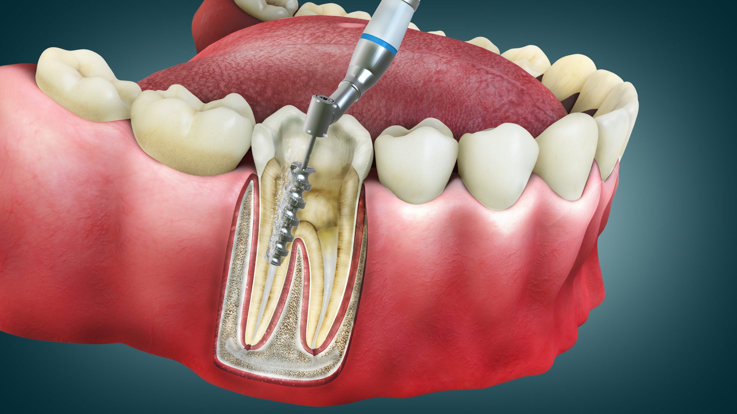 Root Canals